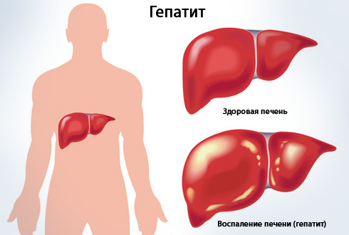 Противопоказания при гепатите