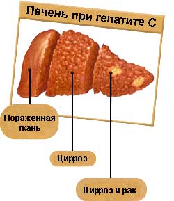 Разрушение стереотипов: государственные клиники и ВГС - фото № 2