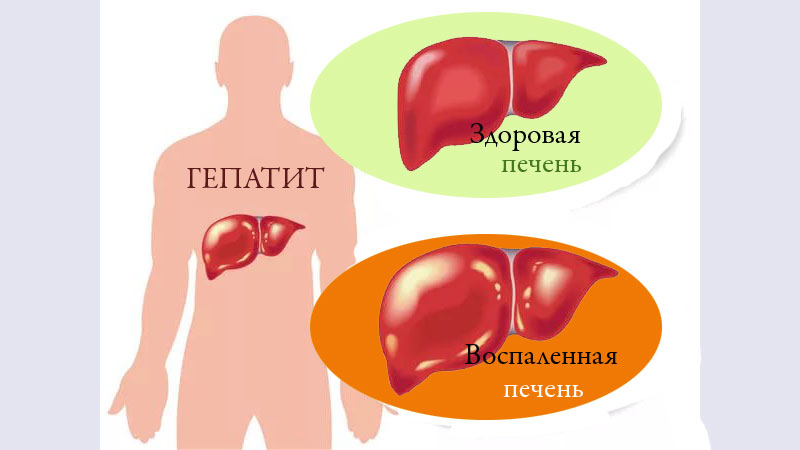 Исключение вероятности осложнений при вирусном гепатите С - фото № 1