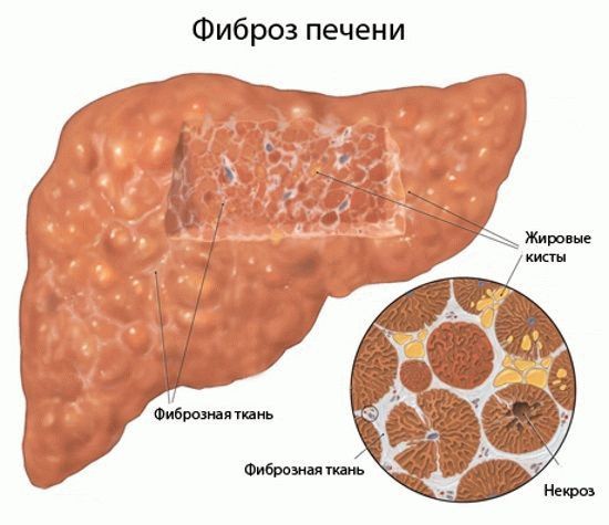 Противовирусная терапия в лечении гепатита С – правила, которых следует придерживаться - фото № 1