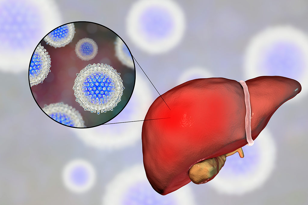Тайная болезнь миллионов: вирусный гепатит С - фото № 1