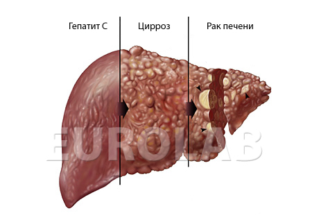Почему необходимо лечить хронический гепатит - фото № 2