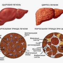 Цирроз печени: причины, симптомы и лечение