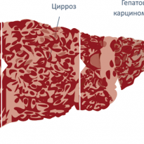 Гепатит С: болезнь есть, нормативов нет