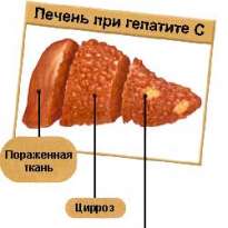 Физиологические проявления гепатита С